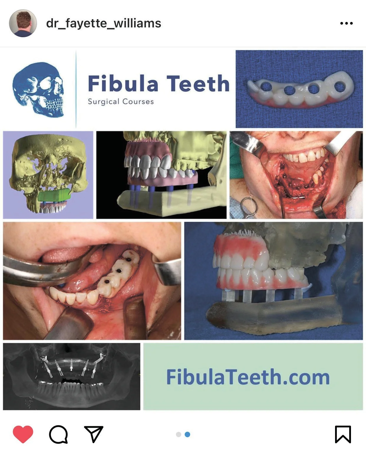Публікація доктора Фаєтта Вільямса в Instagram про хірургічний курс Fibula Teeth