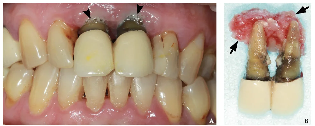 Figure 1. Intraoral view with purulent discharge and extracted teeth with periapical lesions