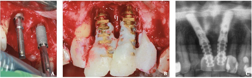 Figure 2. Intraoperative view of implant placement, temporary crowns and radiography